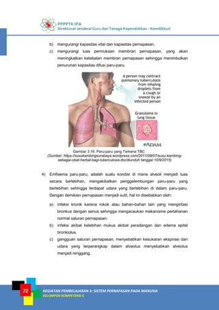 PPPPTK IPA
Direktorat Jenderal Guru dan Tenaga Kependidikan - Kemdikbud
KEGIATAN PEMBELAJARAN 3: SISTEM PERNAFASAN PADA MANUSIA
KELOMPOK KOMPETENSI C
72
b) mengurangi kapasitas vital dan kapasitas pernapasan,
c) mengurangi luas permukaan membran pernapasan, yang akan
meningkatkan ketebalan membran pernapasan sehingga menimbulkan
penurunan kapasitas difusi paru-paru.
Gambar 3.16. Paru-paru yang Terkena TBC
(Sumber: https://susukambingsurabaya.wordpress.com/2011/08/07/susu-kambing-
sebagai-obat-herbal-bagi-tuberculosis-tbc/diunduh tanggal 10/9/2015)
4) Emfisema paru-paru, adalah suatu kondisi di mana alveoli menjadi luas
secara berlebihan, mengakibatkan penggelembungan paru-paru yang
berlebihan sehingga terdapat udara yang berlebihan di dalam paru-paru.
Dengan demikian pernapasan menjadi sulit, hal ini disebabkan oleh:
a) infeksi kronik karena rokok atau bahan-bahan lain yang mengiritasi
bronkus dengan serius sehingga mengacaukan mekanisme pertahanan
normal saluran pernapasan.
b) infeksi akibat kelebihan mukus akibat peradangan dan edema epitel
bronkiolus.
c) gangguan saluran pernapasan, menyebabkan kesukaran ekspirasi dan
udara yang terperangkap dalam alveolus menyebabkan alveolus
menjadi renggang.
 