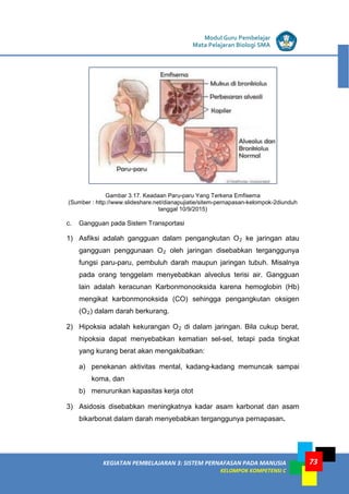 LISTRIK untuk SMP
KEGIATAN PEMBELAJARAN 3: SISTEM PERNAFASAN PADA MANUSIA
KELOMPOK KOMPETENSI C
Modul Guru Pembelajar
Mata Pelajaran Biologi SMA
73
Gambar 3.17. Keadaan Paru-paru Yang Terkena Emfisema
(Sumber : http://www.slideshare.net/dianapujiatie/sitem-pernapasan-kelompok-2diunduh
tanggal 10/9/2015)
c. Gangguan pada Sistem Transportasi
1) Asfiksi adalah gangguan dalam pengangkutan O2 ke jaringan atau
gangguan penggunaan O2 oleh jaringan disebabkan terganggunya
fungsi paru-paru, pembuluh darah maupun jaringan tubuh. Misalnya
pada orang tenggelam menyebabkan alveolus terisi air. Gangguan
lain adalah keracunan Karbonmonooksida karena hemoglobin (Hb)
mengikat karbonmonoksida (CO) sehingga pengangkutan oksigen
(O2) dalam darah berkurang.
2) Hipoksia adalah kekurangan O2 di dalam jaringan. Bila cukup berat,
hipoksia dapat menyebabkan kematian sel-sel, tetapi pada tingkat
yang kurang berat akan mengakibatkan:
a) penekanan aktivitas mental, kadang-kadang memuncak sampai
koma, dan
b) menurunkan kapasitas kerja otot
3) Asidosis disebabkan meningkatnya kadar asam karbonat dan asam
bikarbonat dalam darah menyebabkan terganggunya pernapasan.
 