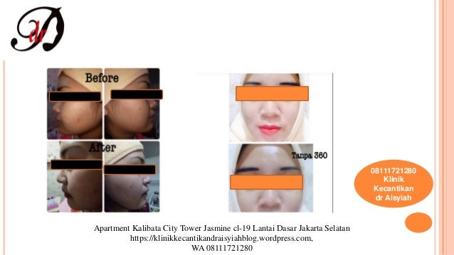 08111721280, skin care yang bagus untuk kulit berminyak 