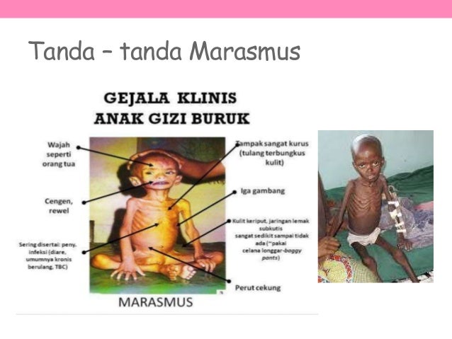 Kurang Kalori Protein