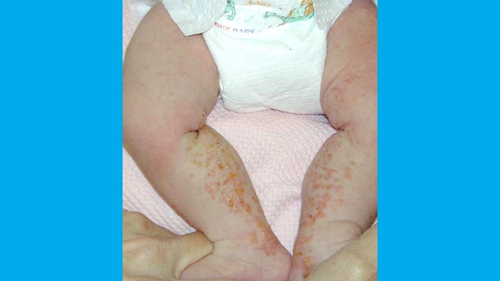 INCONTINENTIA PIGMENTI