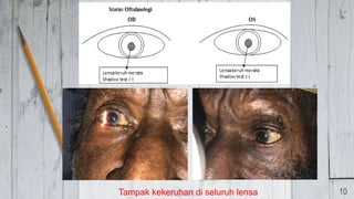 Tampak kekeruhan di seluruh lensa 10
 