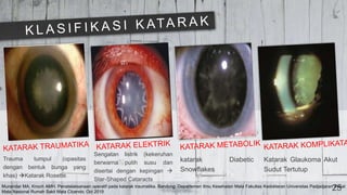 25
Trauma tumpul (opasitas
dengan bentuk bunga yang
khas) Katarak Rosette.
Sengatan listrik (kekeruhan
berwarna putih susu dan
disertai dengan kepingan 
Star-Shaped Cataracts
katarak Diabetic
Snowflakes
Katarak Glaukoma Akut
Sudut Tertutup
Munandar MA, Knoch AMH. Penatalaksanaan operatif pada katarak traumatika. Bandung: Departemen Ilmu Kesehatan Mata Fakultas Kedokteran Universitas Padjadjaran Pusat
Mata Nasional Rumah Sakit Mata CIcendo; Oct 2019
 
