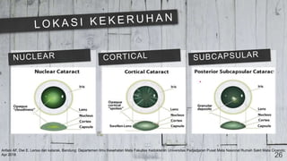 Arifani AF, Dwi E. Lensa dan katarak. Bandung: Departemen Ilmu Kesehatan Mata Fakultas Kedokteran Universitas Padjadjaran Pusat Mata Nasional Rumah Sakit Mata Cicendo;
Apr 2018 26
 