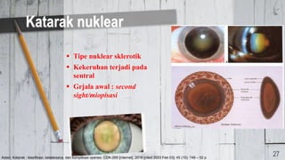  Tipe nuklear sklerotik
 Kekeruhan terjadi pada
sentral
 Grjala awal : second
sight/miopisasi
Katarak nuklear
27
Astari. Katarak : klasifikasi, tatalaksana, dan komplikasi operasi. CDK-269 [internet]. 2018 [cited 2023 Feb 03]; 45 (10): 748 – 52 p
 