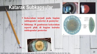 Kekeruhan terjadi pada bagian
subkapsuler anterior & posterior
 Slitlamp  gambaran kekeruhan
seperti plak di bagian korteks
subkapsular posterior
Katarak Subkapsular
29
Astari. Katarak : klasifikasi, tatalaksana, dan komplikasi operasi. CDK-269 [internet]. 2018 [cited 2023 Feb 03]; 45 (10): 748 – 52 p
 