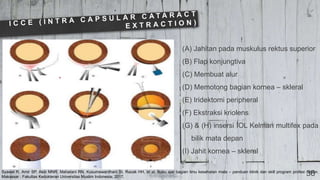 Syawal R, Amir SP, Akib MNR, Maharani RN, Kusumawardhani SI, Razak HH, et al. Buku ajar bagian ilmu kesehatan mata – panduan klinik dan skill program profesi dokter.
Makassar : Fakultas Kedokteran Universitas Muslim Indonesia; 2017.
36
(A) Jahitan pada muskulus rektus superior
(B) Flap konjungtiva
(C) Membuat alur
(D) Memotong bagian kornea – skleral
(E) Iridektomi peripheral
(F) Ekstraksi kriolens
(G) & (H) insersi IOL Kelman multifex pada
bilik mata depan
(I) Jahit kornea – skleral
 