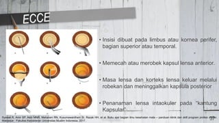 • Insisi dibuat pada limbus atau kornea perifer,
bagian superior atau temporal.
• Memecah atau merobek kapsul lensa anterior.
• Masa lensa dan korteks lensa keluar melalui
robekan dan meninggalkan kapsula posterior
• Penanaman lensa intaokuler pada “kantung
Kapsular”
37
Syawal R, Amir SP, Akib MNR, Maharani RN, Kusumawardhani SI, Razak HH, et al. Buku ajar bagian ilmu kesehatan mata – panduan klinik dan skill program profesi dokter.
Makassar : Fakultas Kedokteran Universitas Muslim Indonesia; 2017.
 