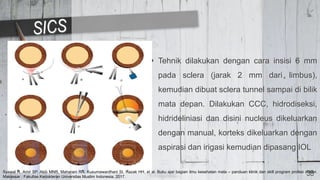 Tehnik dilakukan dengan cara insisi 6 mm
pada sclera (jarak 2 mm dari limbus),
kemudian dibuat sclera tunnel sampai di bilik
mata depan. Dilakukan CCC, hidrodiseksi,
hidrideliniasi dan disini nucleus dikeluarkan
dengan manual, korteks dikeluarkan dengan
aspirasi dan irigasi kemudian dipasang IOL
38
Syawal R, Amir SP, Akib MNR, Maharani RN, Kusumawardhani SI, Razak HH, et al. Buku ajar bagian ilmu kesehatan mata – panduan klinik dan skill program profesi dokter.
Makassar : Fakultas Kedokteran Universitas Muslim Indonesia; 2017.
 
