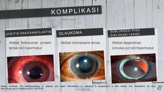 42
Akibat kebocoran protein
lensa std.hipermatur
Akibat intumesens lensa Akibat degenerasi
zonules pd std.hipermatur
Nartey, Andrews. The pathophysiology of cataract and major interventions to retarding its progression: a mini review. Adv Ophthalmol Vis Syst, 2017.
http://dx.doi.org/10.15406/aovs.2017.06.00178
 