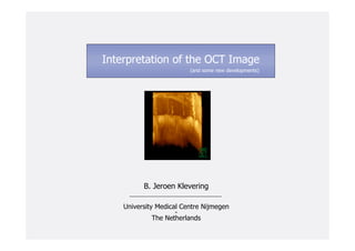 Interpretation of the OCT Image
                         (and some new developments)




          B. Jeroen Klevering

    University Medical Centre Nijmegen
                     -
              The Netherlands
 