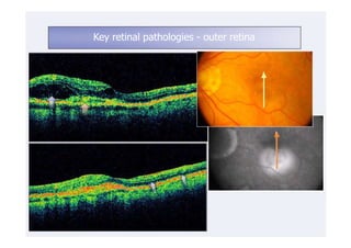 Key retinal pathologies - outer retina
 