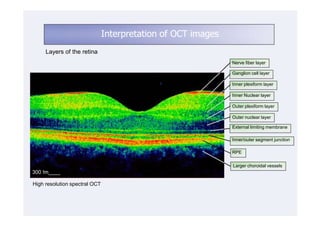 Interpretation of OCT images
     Layers of the retina
                                                              Nerve fiber layer

                                                              Ganglion cell layer

                                                              Inner plexiform layer

                                                              Inner Nuclear layer

                                                              Outer plexiform layer

                                                              Outer nuclear layer

                                                              External limiting membrane

                                                              Inner/outer segment junction

                                                              RPE

                                                              Larger choroidal vessels
300 !m____

High resolution spectral OCT
 
