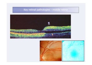 Key retinal pathologies - middle retina
 