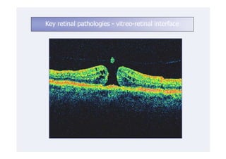 Key retinal pathologies - vitreo-retinal interface
 