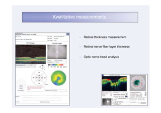 Kwalitative measurements



           ─ Retinal thickness measurement


           ─ Retinal nerve fiber layer thickness


           ─ Optic nerve head analysis
 