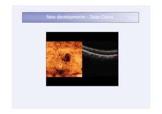 New developments - Zeiss Cirrus
 