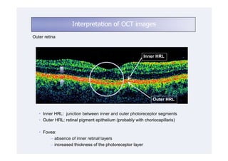 Interpretation of OCT images
Outer retina



                                                           Inner HRL




                                                              Outer HRL


   • Inner HRL: junction between inner and outer photoreceptor segments
   • Outer HRL: retinal pigment epithelium (probably with choriocapillaris)

   • Fovea:
        ─ absence of inner retinal layers
        ─ increased thickness of the photoreceptor layer
 