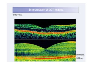 Interpretation of OCT images
Outer retina




                                              High resolution
                                              Spectral Domain
                                              (Fourier
                                              Domain OCT)
 