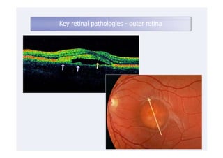 Key retinal pathologies - outer retina
 