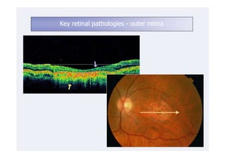 Key retinal pathologies - outer retina
 