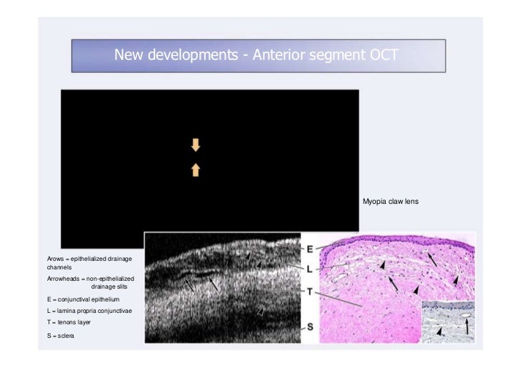 optical coherence tomography interprentation