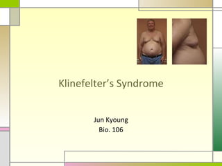 Klinefelter’s Syndrome Jun Kyoung Bio. 106 