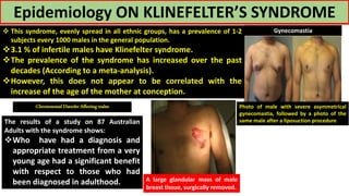 Photo of male with severe asymmetrical
gynecomastia, followed by a photo of the
same male after a liposuction procedure
Gynecomastia
Epidemiology ON KLINEFELTER’S SYNDROME
A large glandular mass of male
breast tissue, surgically removed.
 This syndrome, evenly spread in all ethnic groups, has a prevalence of 1-2
subjects every 1000 males in the general population.
3.1 % of infertile males have Klinefelter syndrome.
The prevalence of the syndrome has increased over the past
decades (According to a meta-analysis).
However, this does not appear to be correlated with the
increase of the age of the mother at conception.
The results of a study on 87 Australian
Adults with the syndrome shows:
Who have had a diagnosis and
appropriate treatment from a very
young age had a significant benefit
with respect to those who had
been diagnosed in adulthood.
-Chromosomal Disorder Affecting males-
 
