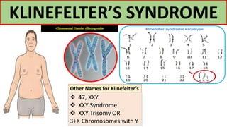 KLINEFELTER’S SYNDROME
Other Names for Klinefelter’s
 47, XXY
 XXY Syndrome
 XXY Trisomy OR
3+X Chromosomes with Y
-Chromosomal Disorder Affecting males-
 