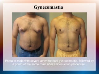 Klinefelter syndrome | PPT