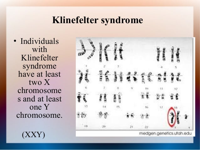 Klinefelter syndrome