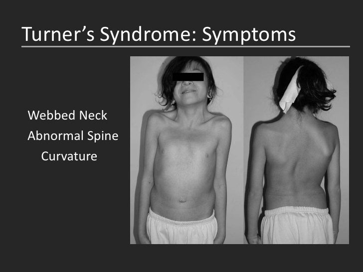 webbed neck syndrome