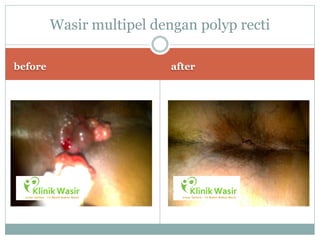 Wasir multipel dengan polyp recti

before                     after
 