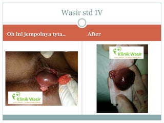 Wasir std IV

Oh ini jempolnya tyta..     After
 