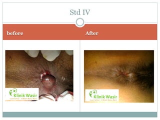 Std IV

before       After
 