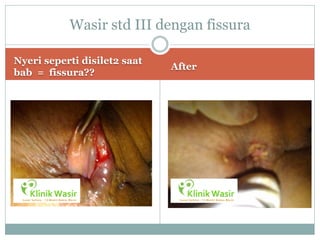 Wasir std III dengan fissura

Nyeri seperti disilet2 saat
                              After
bab = fissura??
 