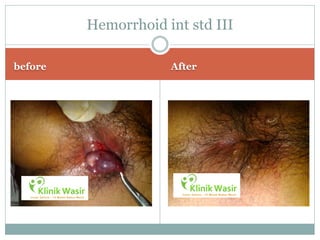 Hemorrhoid int std III

before               After
 