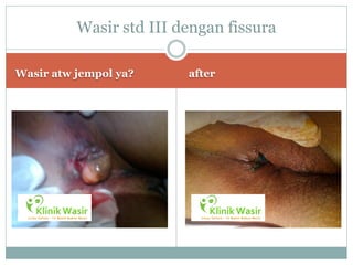 Wasir std III dengan fissura

Wasir atw jempol ya?     after
 