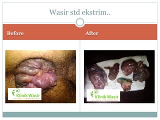 Wasir std ekstrim..

Before              After
 