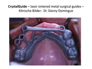 CrystalGuide – laser sintered metal surgical guides –
       Klinische Bilder: Dr. Danny Domingue
 