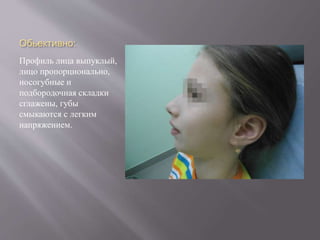 Обьективно:
Профиль лица выпуклый,
лицо пропорционально,
носогубные и
подбородочная складки
сглажены, губы
смыкаются с легким
напряжением.
 