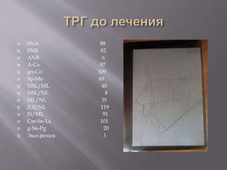  SNA 88
 SNB 82
 ANB 6
 A-Co 87
 gn-Co 109
 Sp-Me 69
 NSL/ML 40
 NSL/NL 8
 ML/NL 35
 JLS/NL 119
 Jli/ML 91
 Cm-Sn-Ls 101
 g-Sn-Pg 20
 Эксн.резцов 3
 