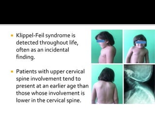 Feil Klippel-Feil Syndrome | PPTX