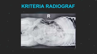 Loopografi Normal Radiologi KLP 1 TR 3 COLON IN LOOP PEDIATRIC.pptx