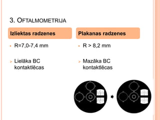 3. OFTALMOMETRIJA
Izliektas radzenes

Plakanas radzenes



R=7,0-7,4 mm



R > 8,2 mm



Lielāka BC
kontaktlēcas



Mazāka BC
kontaktlēcas

 