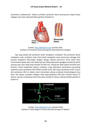  Keperawatan Medikal Bedah I 
16
prosentase sumbatannya? Bahwa sumbatan pembuluh darah jantung bisa terjadi hanya
sebagian atau total, coba perhatikan gambar di bawah ini:
Sumber, http://Slideshare.com, diunduh 2016.
Gambar 2.2 Pembuluh darah jantung dan atheroskelerosis sebagian
Apa yang terjadi bila pembuluh darah mengalami sumbatan? Jika pembuluh darah
mengalami suatu sumbatan maka aliran darah mengalami suatu penurunan sehingga otot
jantung mengalami kekurangan oksigen, dengan adanya penurunan aliran darah akan
memunculkan gejala yaitu nyeri dada tapi nyeri dada pada pasien gangguan pembuluh darah
jantung yaitu nyeri dada yang menjalar ke bahu kiri, rahang dan dada seperti tertindih atau
diremas. Untuk meyakinkan adanya sumbatan, maka diperlukan pemeriksaan penunjang
sederhana yaitu perekaman EKG (Elektro Kardio Grafi). Apa tujuan perekaman EKG? Tujuan
dari perekaman EKG ini adalah untuk memastikan adanya sumbatan (total/sebagian) atau
total. Jika adanya sumbatan sebagian maka pada gambaran EKG akan nampak adanya ST
depresi dan jika sumbatanya total maka akan nampak ST elevasi, coba perhatikan gambar di
bawah ini:
Sumber, http://Slideshare.com, diunduh 2016.
Gambar 2.3 EKG dengan ST Elevasi dan EKG denngan ST Depresi
 