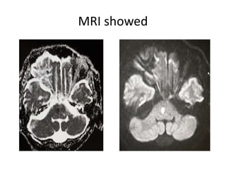 MRI showed
 