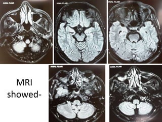 MRI
showed-
 