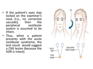 • If the patient’s eyes stay
locked on the examiner’s
nose (i.e., no corrective
saccade), then the
peripheral vestibular
system is assumed to be
intact.
• Thus, when a patient
presents with the acute
vestibular syndrome, the
test result would suggest
a CNS lesion (because the
VOR is intact).
 