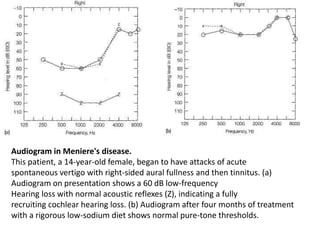 Audiogram in Meniere's disease.
This patient, a 14-year-old female, began to have attacks of acute
spontaneous vertigo with right-sided aural fullness and then tinnitus. (a)
Audiogram on presentation shows a 60 dB low-frequency
Hearing loss with normal acoustic reflexes (Z), indicating a fully
recruiting cochlear hearing loss. (b) Audiogram after four months of treatment
with a rigorous low-sodium diet shows normal pure-tone thresholds.
 